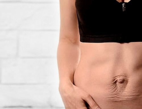 Diástasis abdominal
